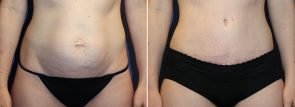 abdominoplasty-liposuction-20012a-berks