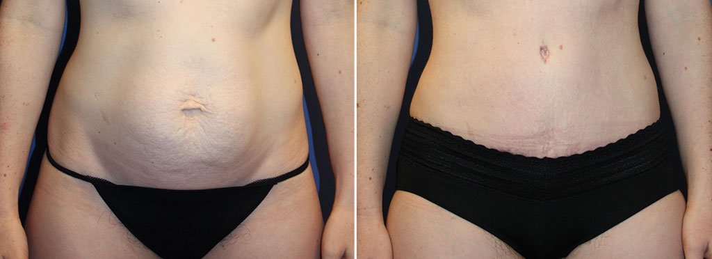 Tummy Tuck Patient 35