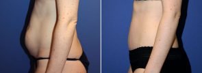 abdominoplasty-liposuction-20012c-berks