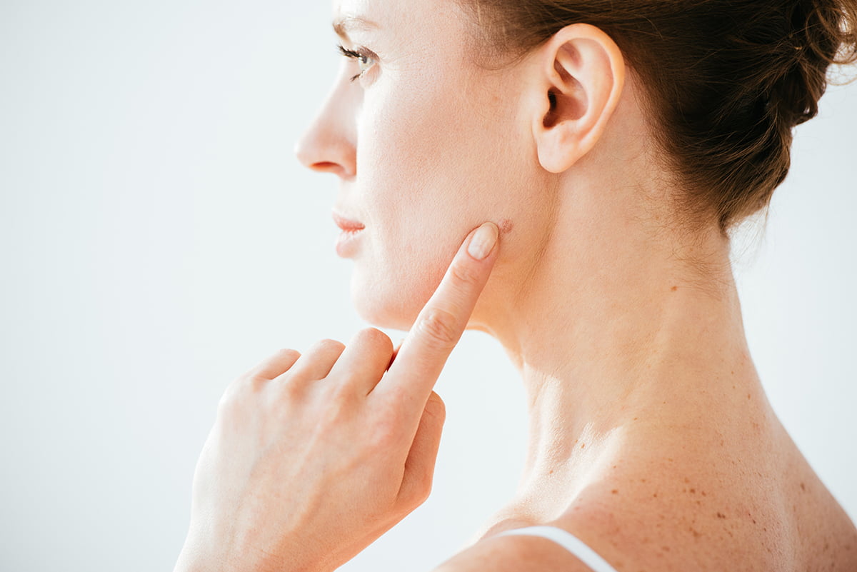 Woman pointing to mole on face