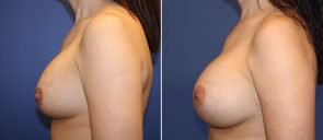 breast-implant-revision-20550c-berks