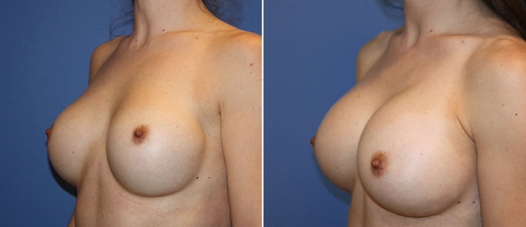 breast-implant-revision-20557b-berks