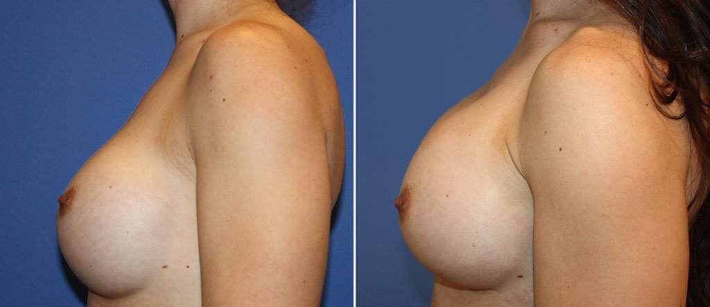 breast-implant-revision-20557c-berks
