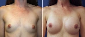 Breast Reconstruction Patient 4