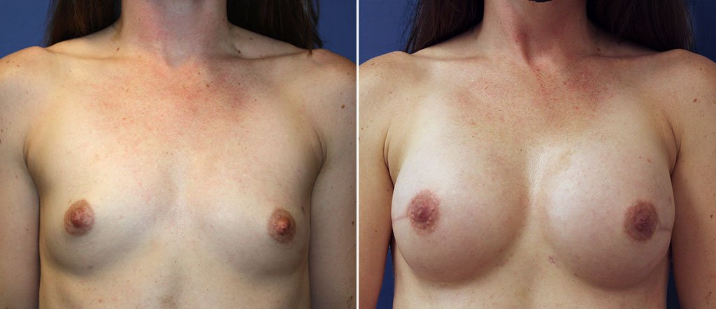 breast-reconstruction-20963a-berks