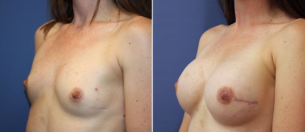 breast-reconstruction-20963b-berks