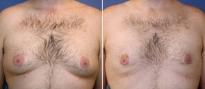 Male Breast Reduction (Gynecomastia) Patient 7