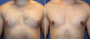 Male Breast Reduction (Gynecomastia) Patient 6