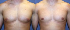 Male Breast Reduction (Gynecomastia) Patient 9