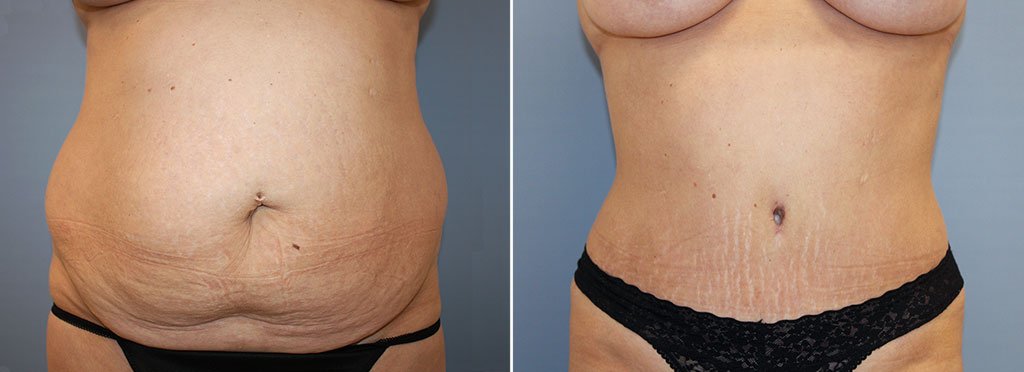 Tummy Tuck Patient 37