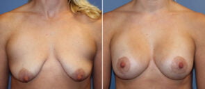 Breast Augmentation with Lift Patient 22