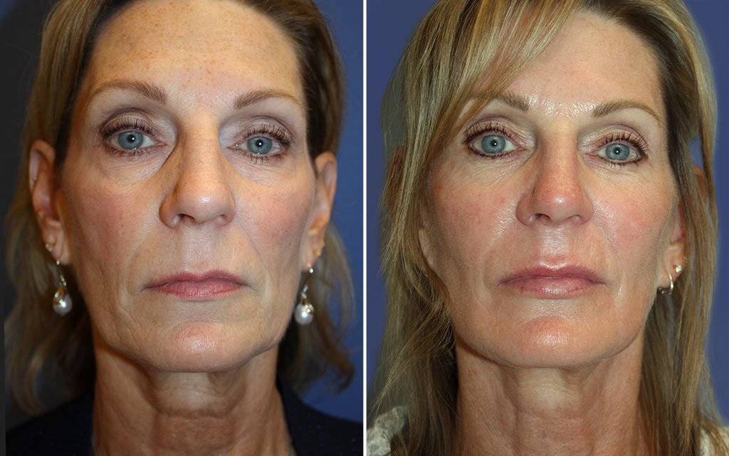 Facelift Patient 5