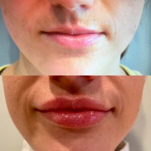 Lip Fillers Natural Volume Before and After