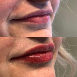 Fine Lines Lip Fillers Before and After