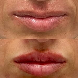 Lip Asymmetry lip enhancement 