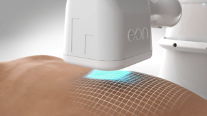 close-up abdomen with EON laser projecting topographical grid onto skin