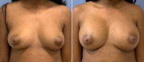 Breast Augmentation Patient 103