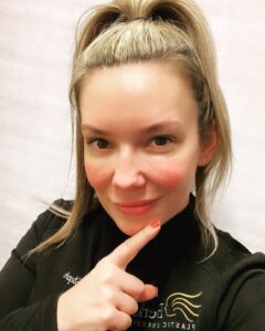 Our Cosmetic Patient Coordinator Steph Shares Her Personal Plastic Surgery Experience