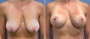 Breast Augmentation with Lift Patient 23
