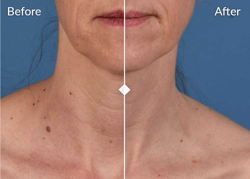 Before and after SkinPen microneedling treatment for neck wrinkles. 