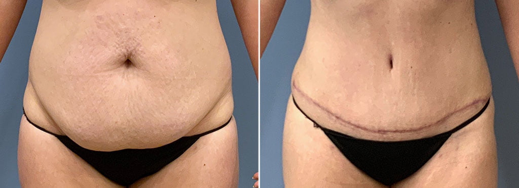 Tummy Tuck Patient 38