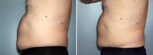 Real male body contouring patient shown before and after 