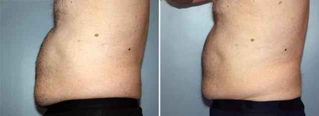 Real male body contouring patient shown before and after