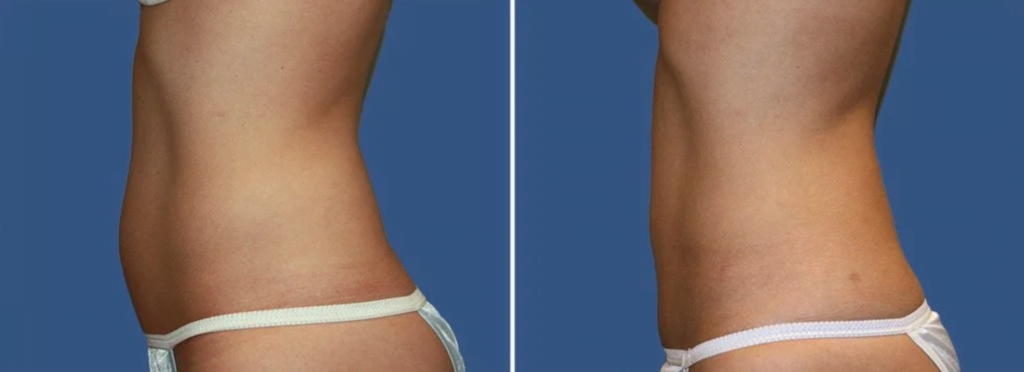 Female patient before and after CoolSculpting at our Reading medspa