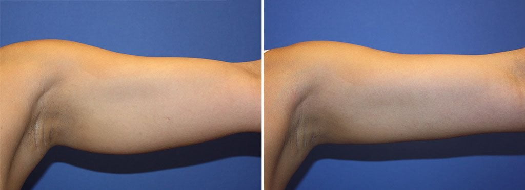 CoolScultping non-surgical arm contouring shown before and after treatment
