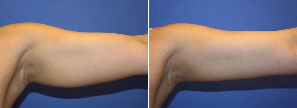 CoolScultping non-surgical arm contouring shown before and after treatment