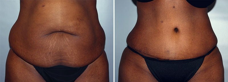 Great results in the stomach area before and after tummy tuck with Dr. Reedy