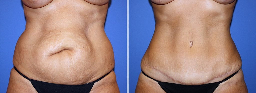 Plastic surgeon Dr. Reedy's tummy tuck provided lift and tuck to the abdomen