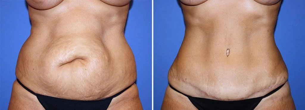 Abdominoplasty (Tummy Tuck)