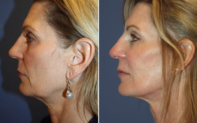 Before and after a facelift surgery procedure with Dr. Lindsay
