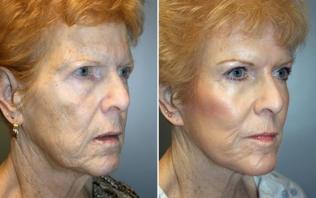 Patient shown before and after facelift with our Dr. saw improvement in facial contour and skin