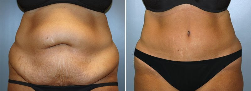 Patient saw significant abdominal reduction before and after tummy tuck with Dr. Reedy
