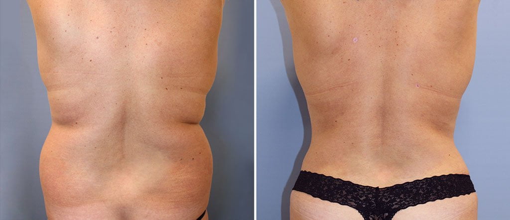 Liposuction technique  performed by Dr. Reedy around the waist for an improved contour and hourlglass shape