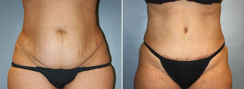 Dr. Reedy performed a tummy tuck with liposuction combination technique to flatten the abdomen. 