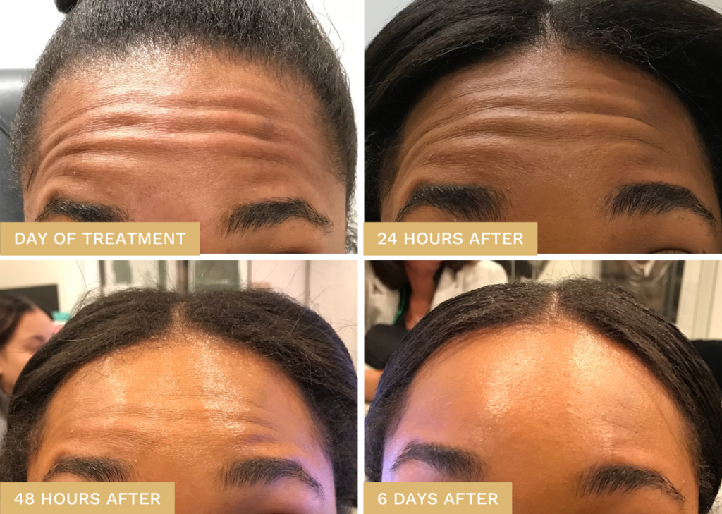 Daxxify before and after