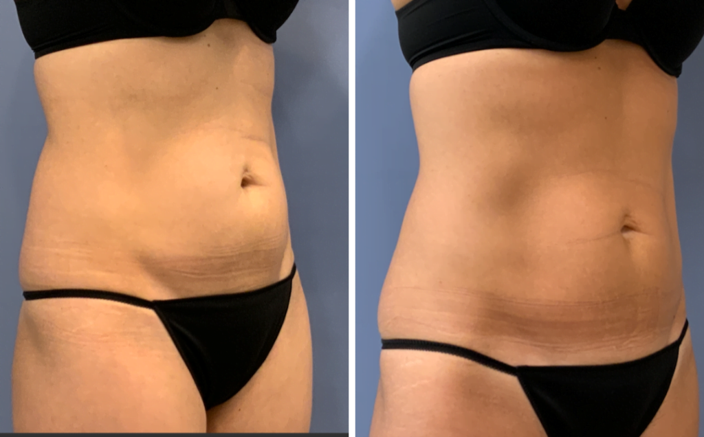Before and after CoolSculpting