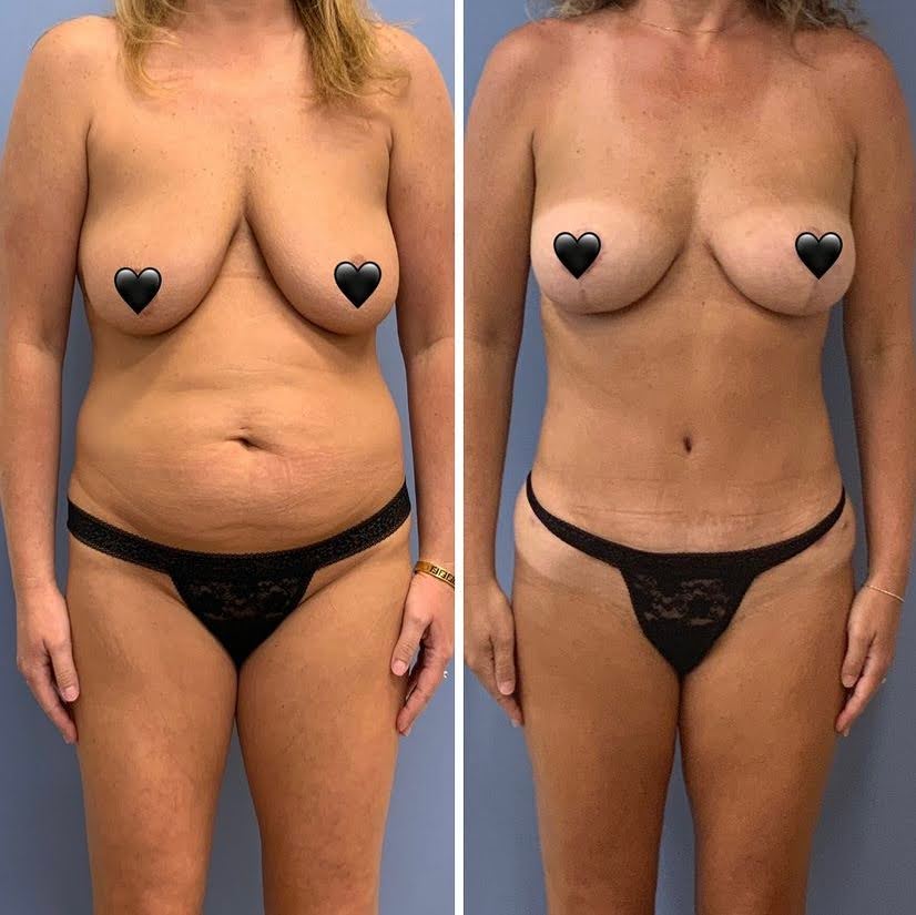 Before and after breast augmentation by Reading plastic surgeon Dr. Brian Reedy