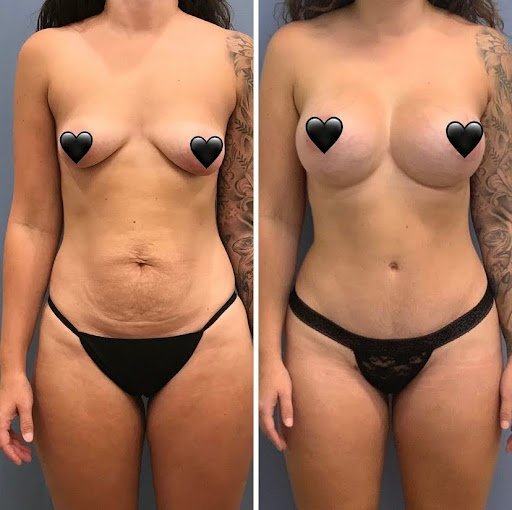 Before and after mommy makeover with breast augmentation, tummy tuck, and liposuction with Reading plastic surgeon Dr. Brian K Reedy