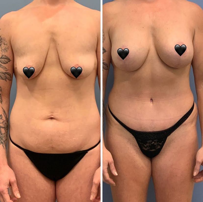 Before and after breast augmentation by Reading plastic surgeon Dr. Brian Reedy