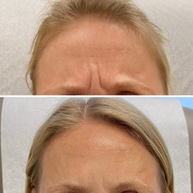 Treatment Area: Glabella