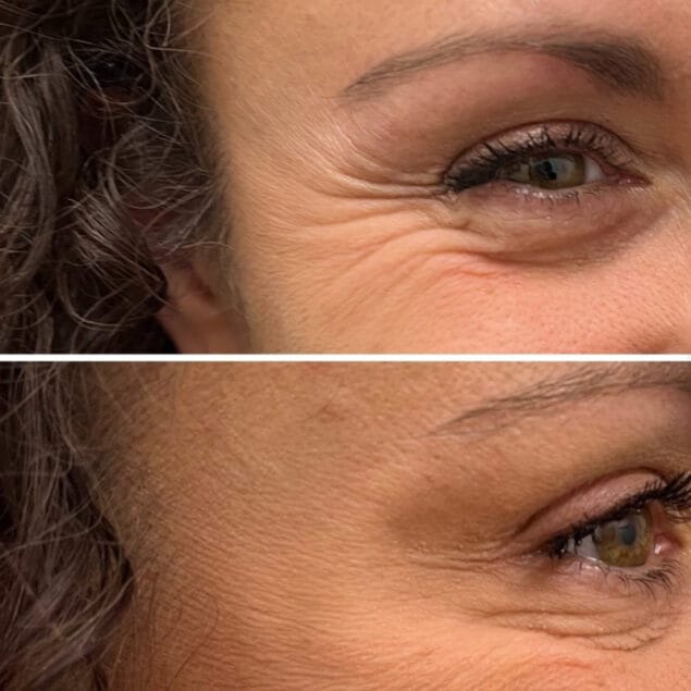 Treatment Area: Crow's Feet (Corners of the eyes)