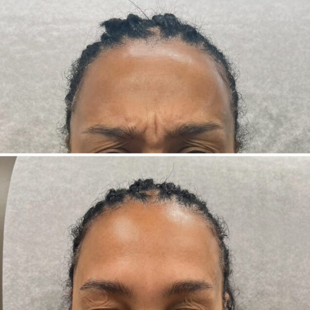 Treatment Area: Glabella