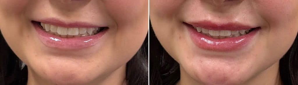 Lip Enhancement