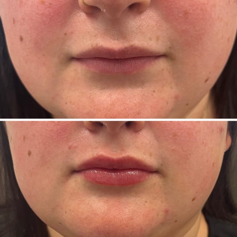 Before and after lip filler at BPS med spa in Reading, PA