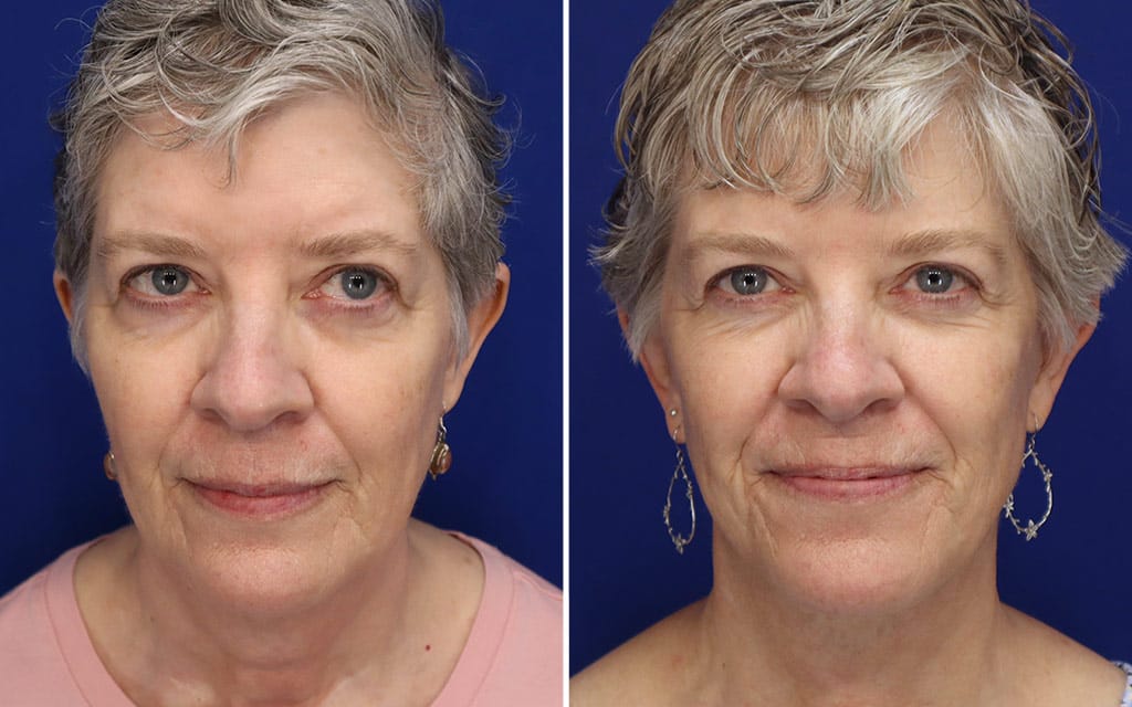 Facelift Patient 6