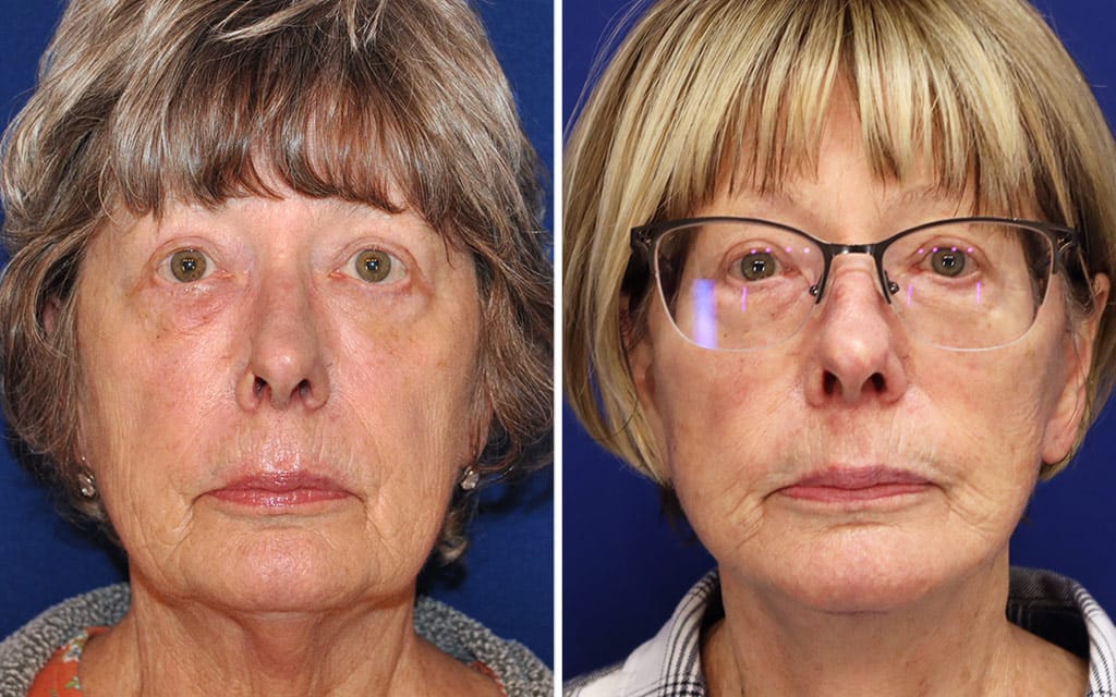 Facelift Patient 7